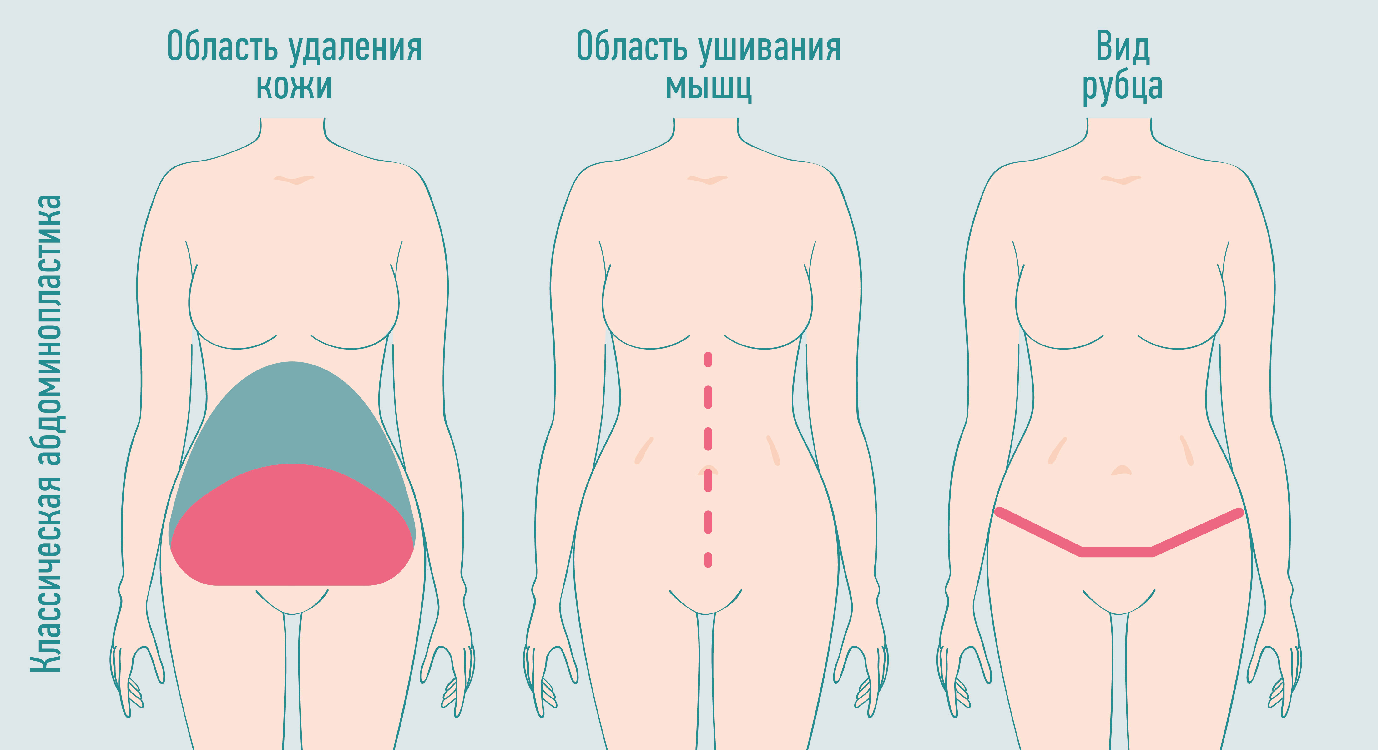 абдоминопластика
